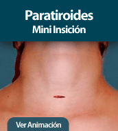Paratiroides - Mini Insición