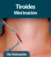 Tiroides Mini Insición